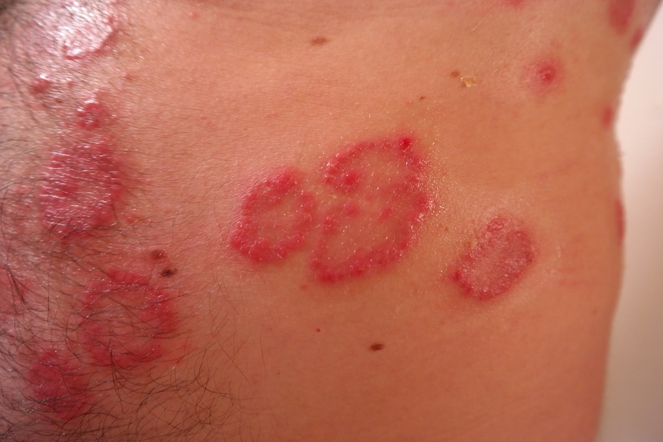 Tratamiento para psoriasis y dermatitis en Vigo 0