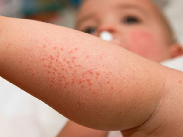 tratamiento dermatitis vigo taiyang